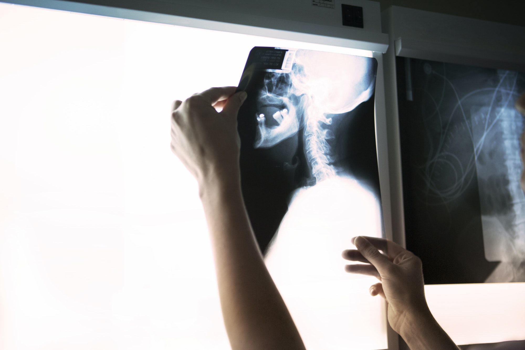 Cropped Image Of Woman Examining Neck X-ray On Diagnostic Medical Tool